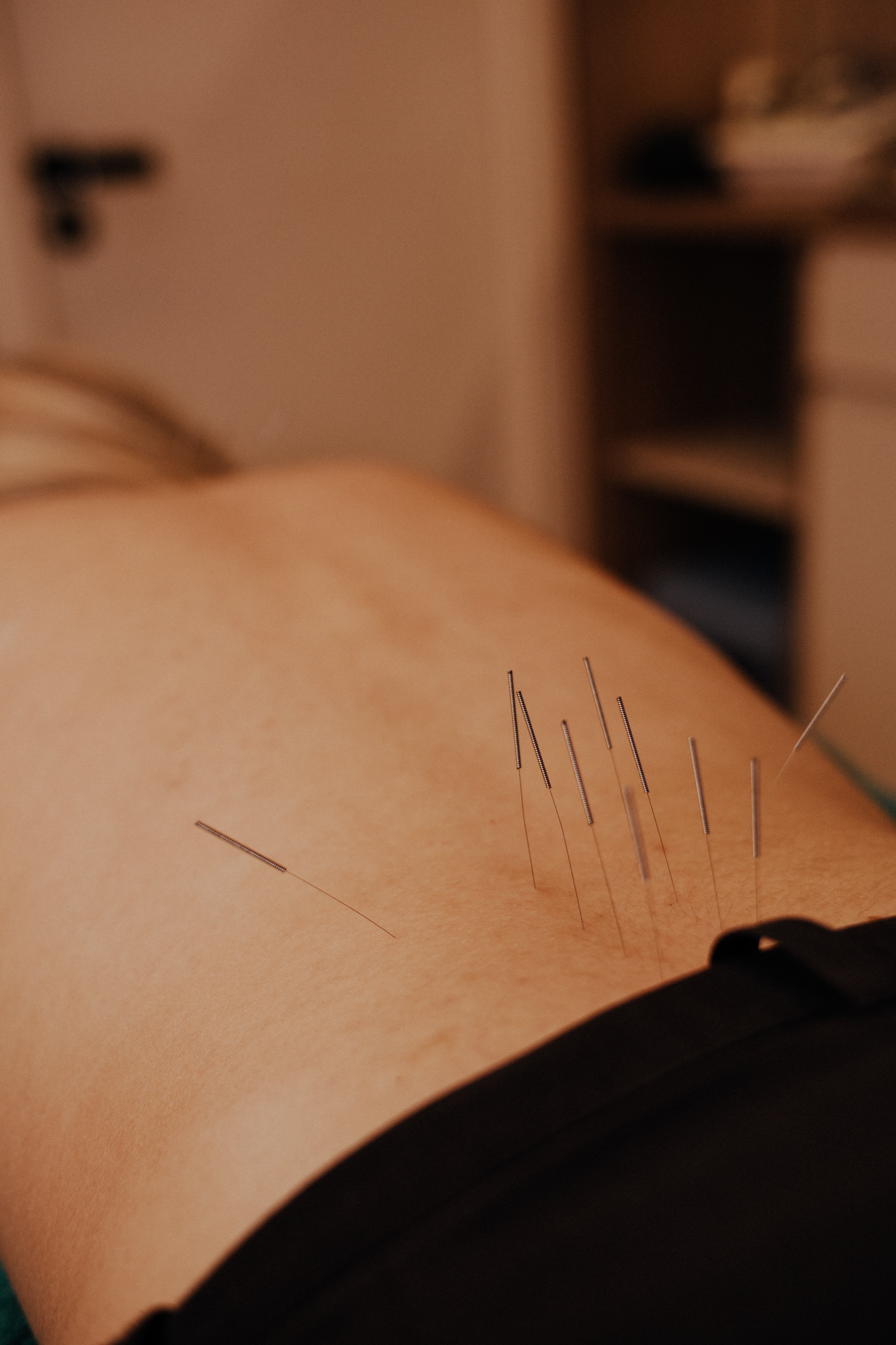 Aplicação de acupuntura em paciente na Clínica Fábio Pense, no bairro Lourdes, Belo Horizonte